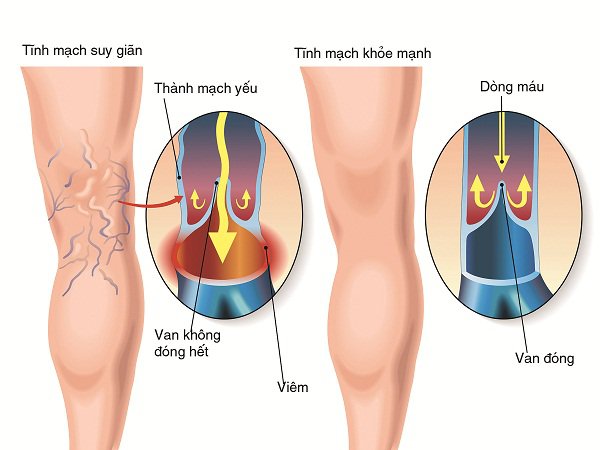 Giảm suy giãn tĩnh mạch bằng cách nào?