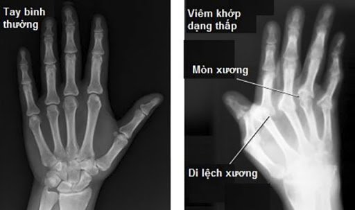 Hình ảnh X-quang viêm khớp dạng thấp