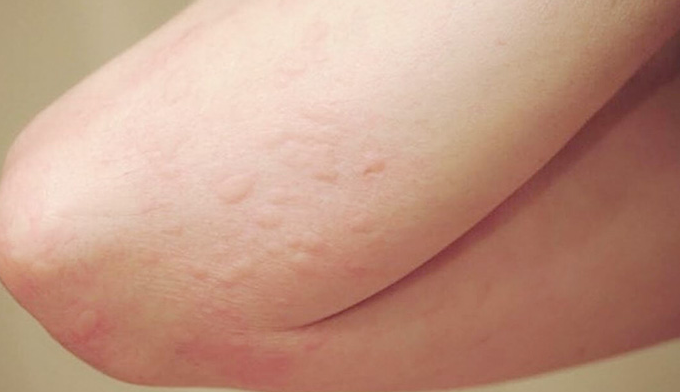 Thuốc Aerius là gì? Thuốc Aerius có phải kháng sinh không?