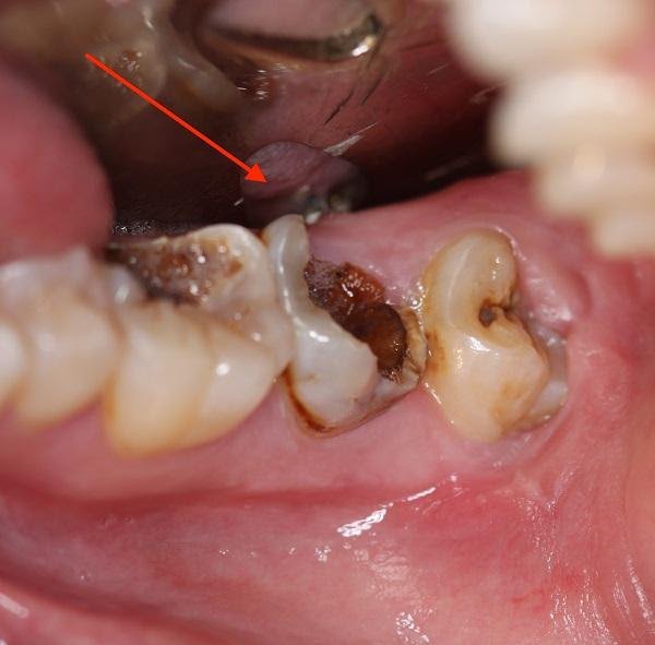 Nguyên tắc điều trị răng hàm sâu bị vỡ chỉ còn chân răng