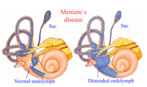 Hội chứng tiền đình: Đặc điểm, phân loại và triệu chứng lâm sàng