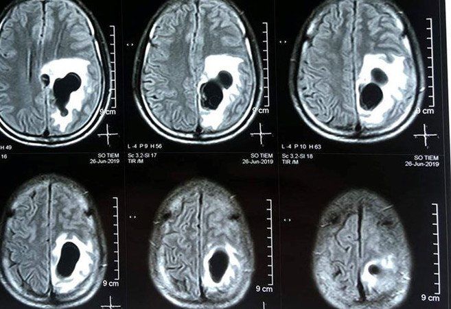 Phần 4: Các nguyên nhân ngoài gen của động kinh