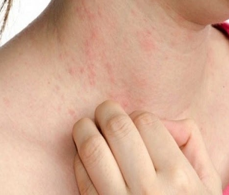 10 dấu hiệu không thể bỏ qua của da nhạy cảm