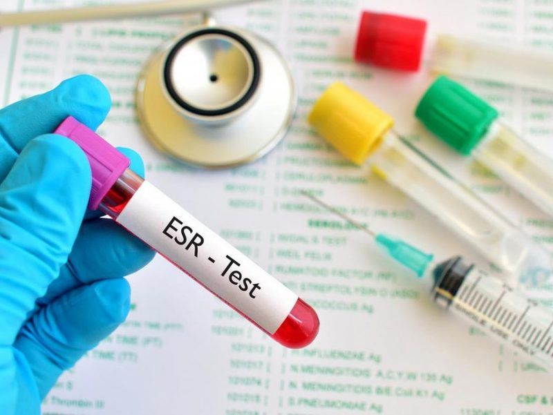 Các xét nghiệm trong Lab dùng để chẩn đoán Lupus