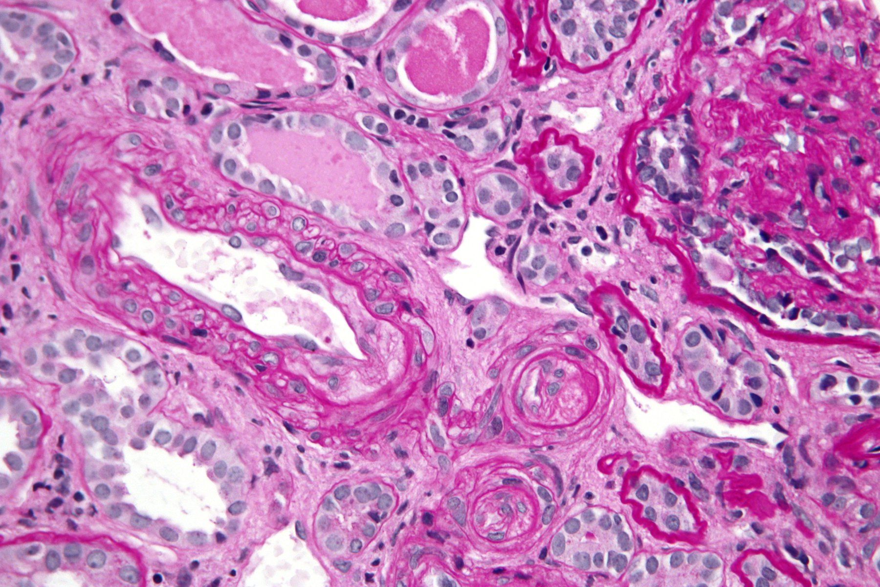 Các xét nghiệm trong Lab dùng để chẩn đoán Lupus