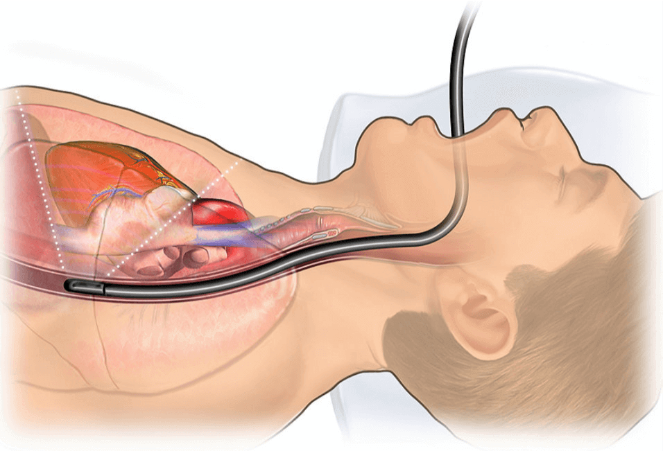 Siêu âm tim qua thực quản có đau không?