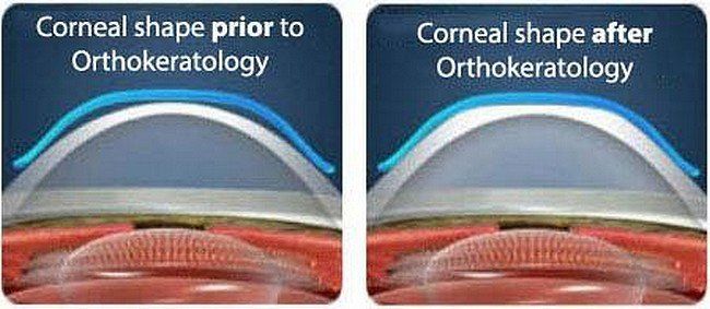 Bạn có thực sự hiểu rõ về Ortho – K?