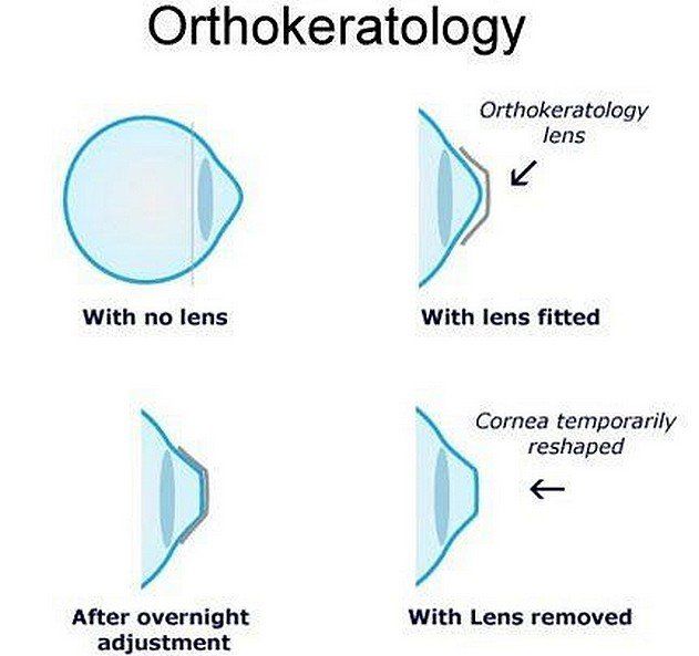 Bạn có thực sự hiểu rõ về Ortho – K?