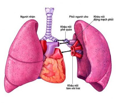 Bệnh phổi kẽ: Những điều cần biết