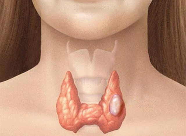 Ý nghĩa xét nghiệm Calcitonin