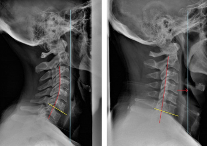 Quy trình chụp X-quang cột sống cổ thẳng nghiêng