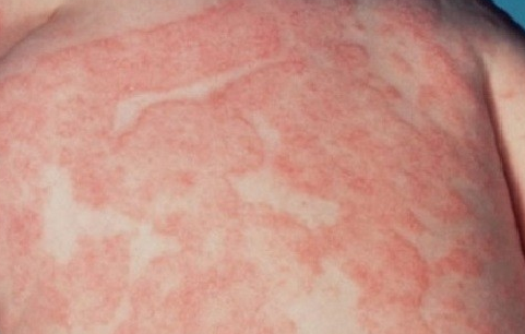 Bệnh vẩy phấn hồng có lây không? Triệu chứng của bệnh là gì?