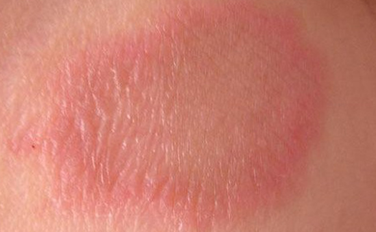 Bệnh vẩy phấn hồng có lây không? Triệu chứng của bệnh là gì?
