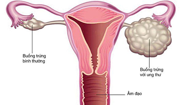Xét nghiệm 12 kháng nguyên: Hội chứng thần kinh cận u