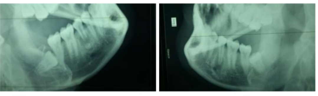 Kỹ thuật chụp x quang hàm chếch