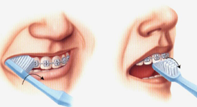 Trồng răng giả bị lung lay: Nguyên nhân và cách khắc phục
