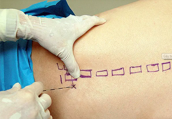 Gây tê tủy sống phẫu thuật cắt u nang buồng trứng