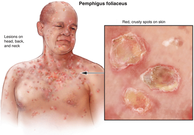 Bệnh Pemphigus: Nguyên nhân, triệu chứng và cách điều trị