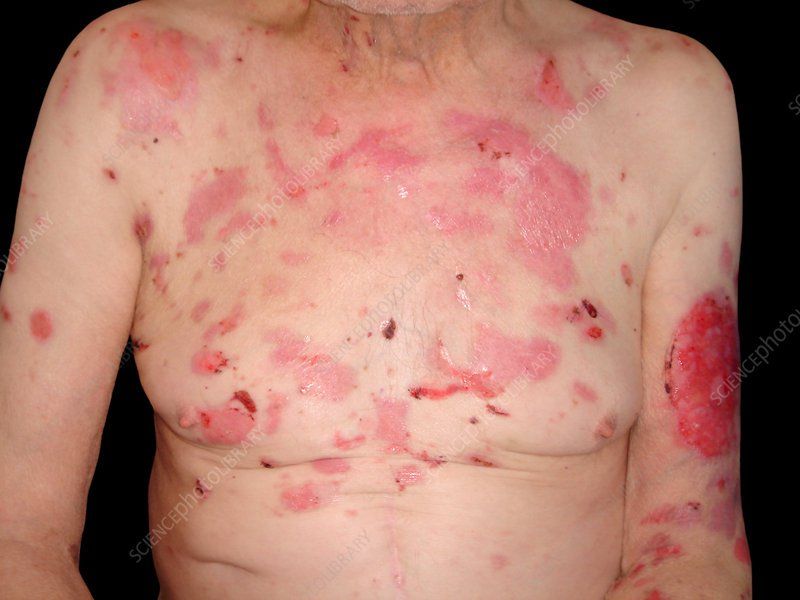Bệnh Pemphigus: Nguyên nhân, triệu chứng và cách điều trị