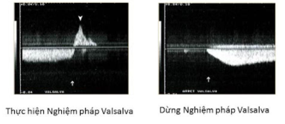 Nghiệm pháp Valsalva siêu âm thoát vị bẹn