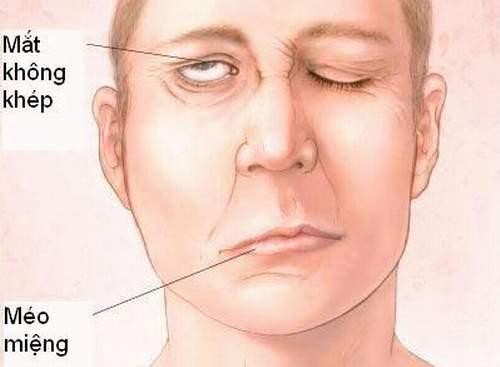 Siêu âm đa thông số khảo sát động mạch cảnh
