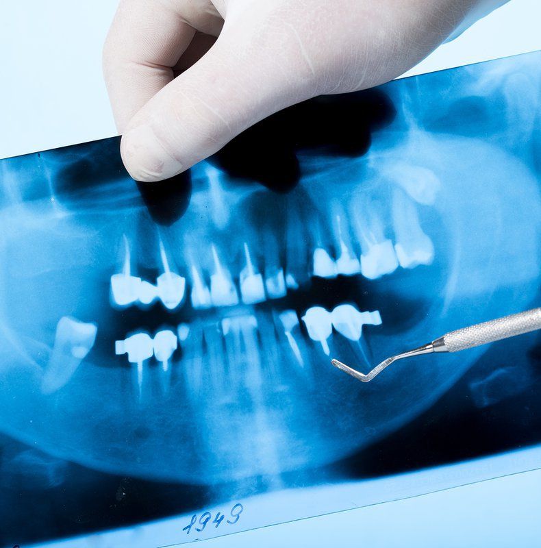 Chẩn đoán và điều trị gãy xương hàm trên