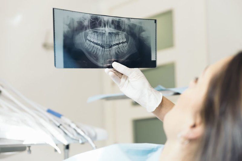 Chụp X-quang răng có những loại nào?