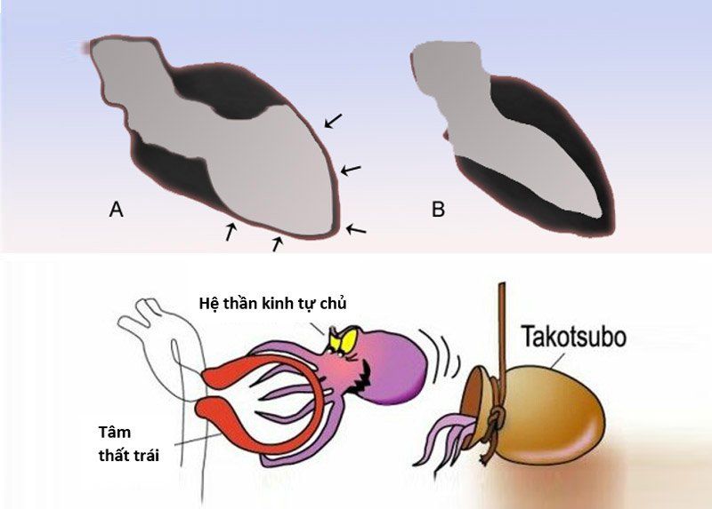 Bệnh cơ tim takotsubo: Triệu chứng, chẩn đoán, cách điều trị