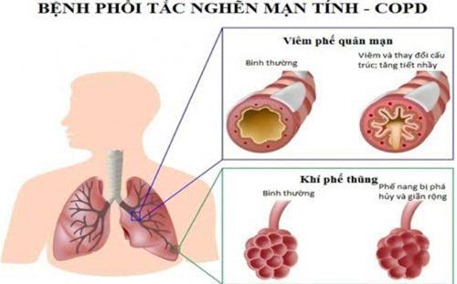Ứng dụng lâm sàng của Tế bào gốc trung mô dây rốn trong điều trị phổi tắc nghẽn mạn tính (COPD)