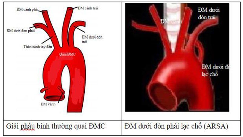 ARSA được xác định trên siêu âm thai như thế nào?