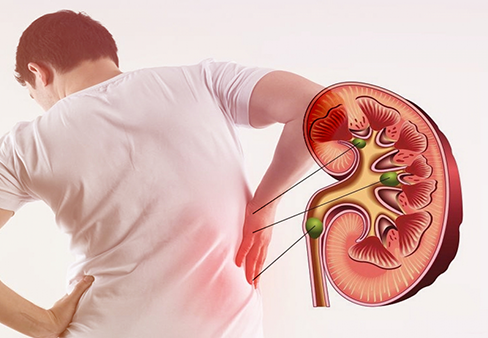 Xử lý cấp cứu cơn đau quặn thận