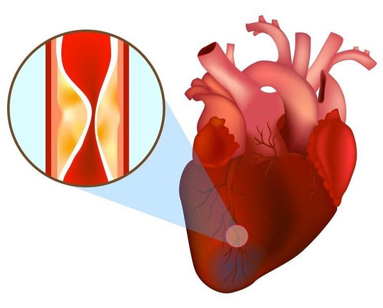 Xét nghiệm CKMB trong nhồi máu cơ tim