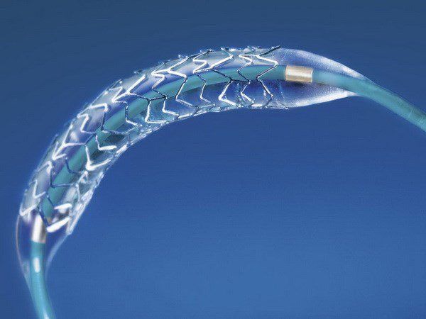 Đặt stent khí – phế quản qua nội soi