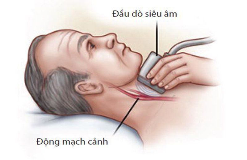 Quy trình thực hiện siêu âm hệ mạch cảnh