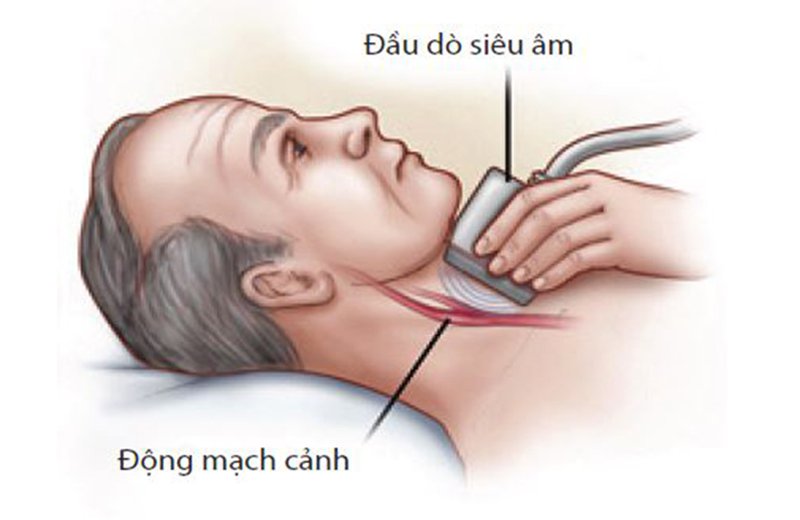 Siêu âm mạch cảnh phát hiện những bệnh lý gì?