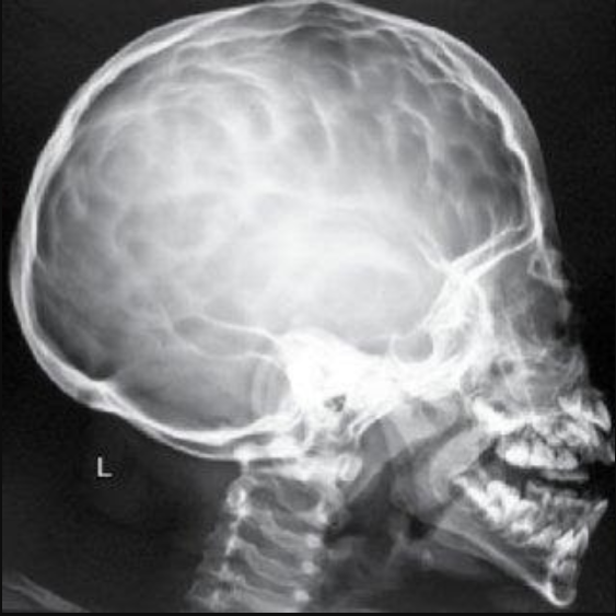 Hướng dẫn đọc phim chụp X - quang sọ não ở tư thế thẳng và nghiêng