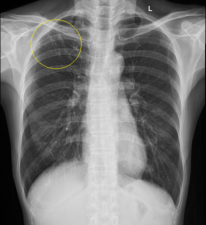 Chụp X - quang phổi có vết mờ là biểu hiện nguy hiểm