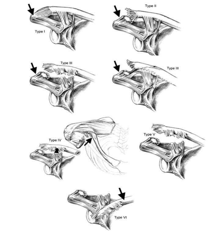 Hình ảnh trật khớp cùng đòn chụp x quang ở tư thế trước và sau