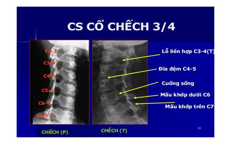 Quy trình chụp X quang cột sống cổ chếch 3⁄4