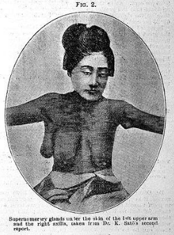 Tuyến vú phụ: Những điều cần biết