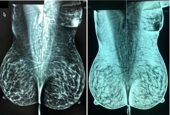 Tuyến vú phụ: Những điều cần biết