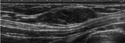 Tuyến vú phụ: Những điều cần biết