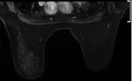 Tuyến vú phụ: Những điều cần biết
