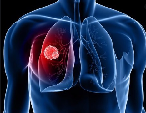 Chỉ định của rửa phổi toàn bộ