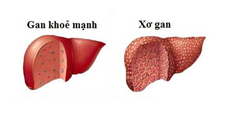Bệnh viêm gan do virus là gì?