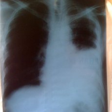 Xuất huyết nội tạng: Nguyên nhân và triệu chứng