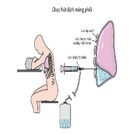 Các bước thực hiện chọc dịch màng phổi cấp cứu