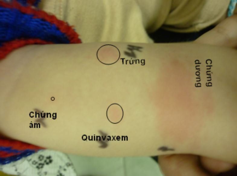 Hướng dẫn tiêm vắc-xin ở bệnh nhân có tiền sử dị ứng