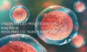 Ứng dụng lâm sàng của Tế bào gốc trung mô dây rốn trong điều trị phổi tắc nghẽn mạn tính (COPD)