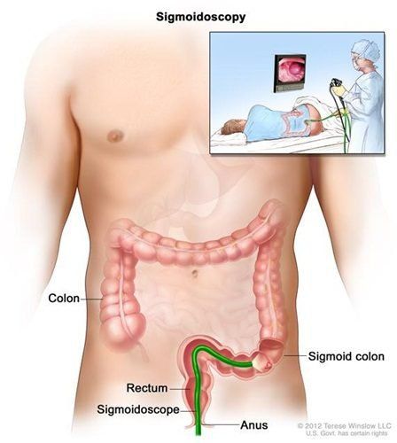 Tìm hiểu về viêm túi thừa Meckel và các biến chứng